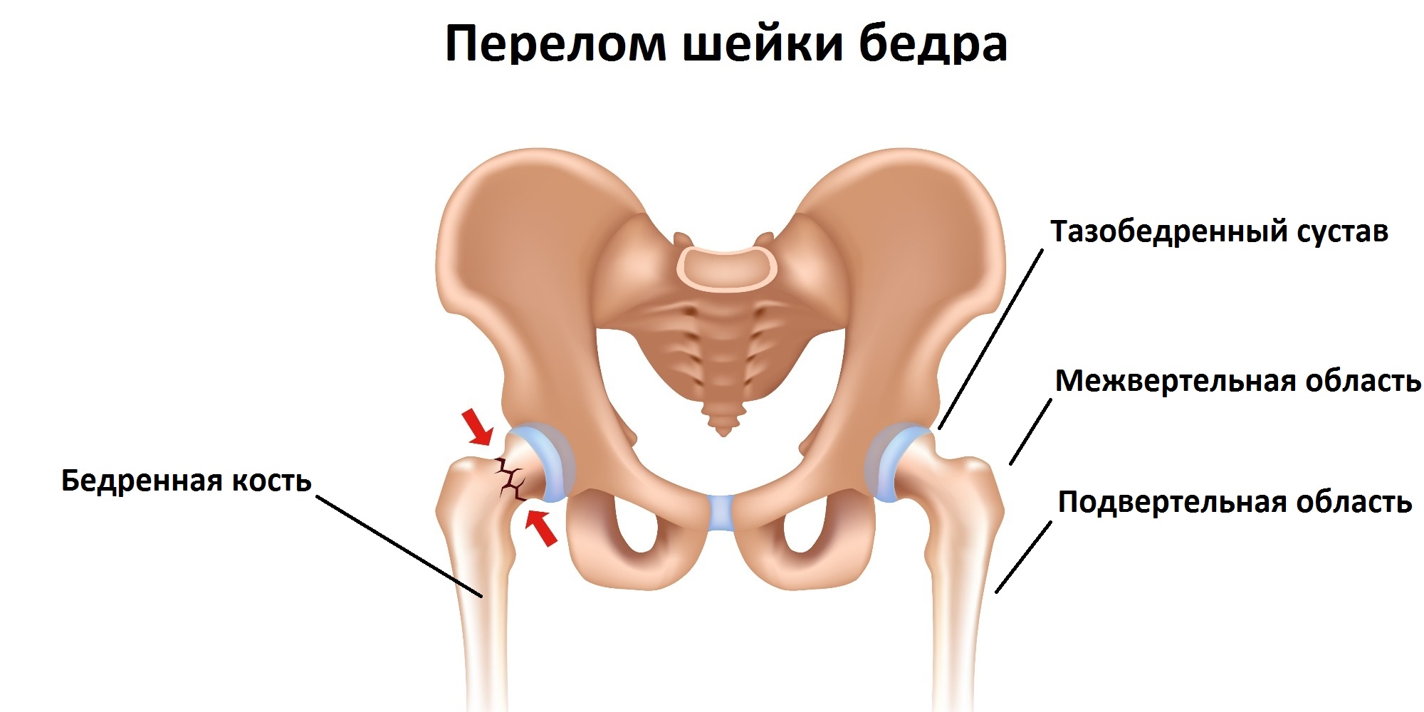 Уход за больным после перелома шейки бедра